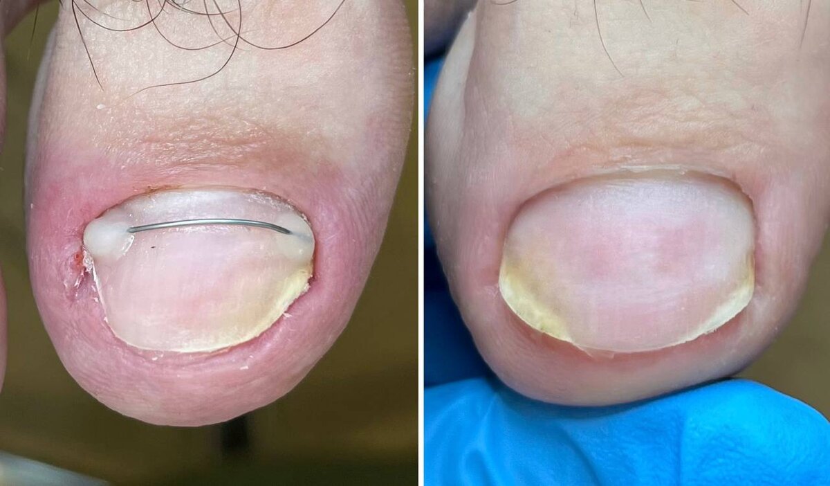 А лечат его чаще всего вот такой корректирующей системой.