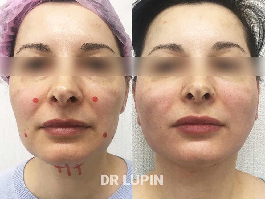 Нитевой лифтинг. На фото пациентка Данилы Лупина. Имеются противопоказания, необходима консультация специалиста.