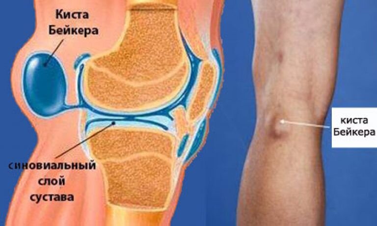 Боль в области колена - это неприятный симптом, который может иметь самые разные причины.-2