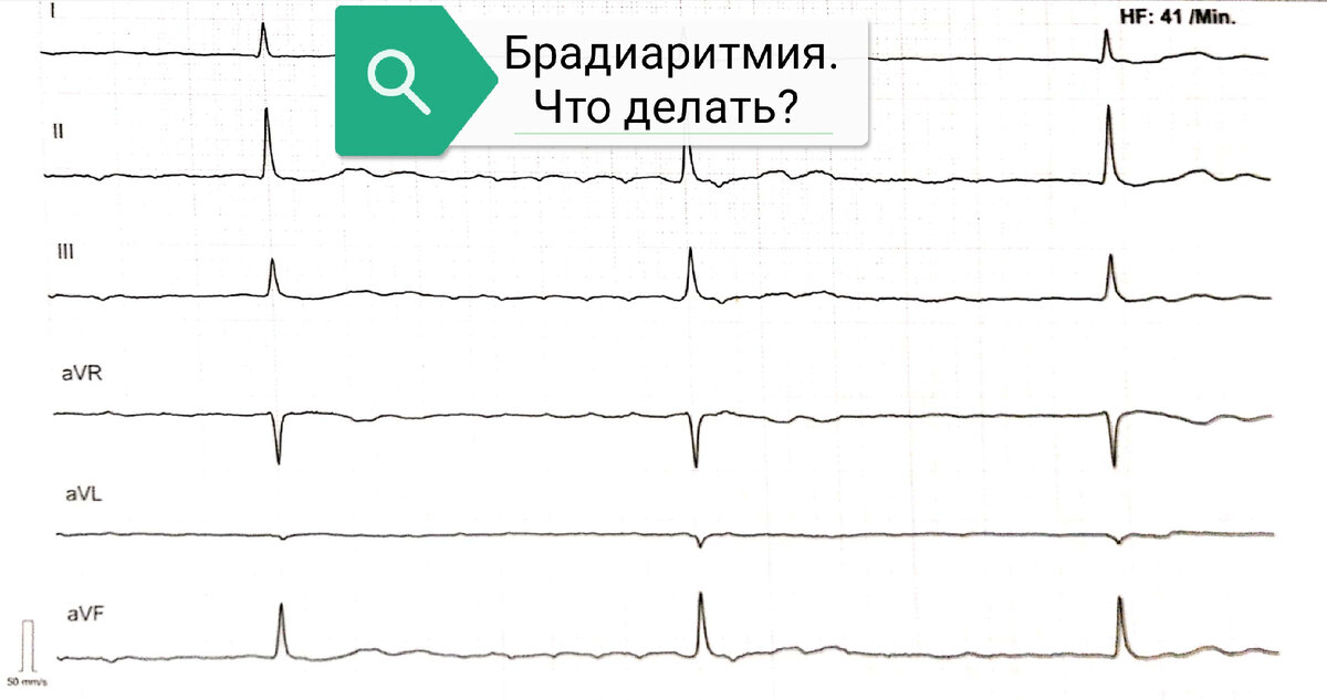 Брадиформа фибрилляции предсердий на ЭКГ(редкий пульс) 