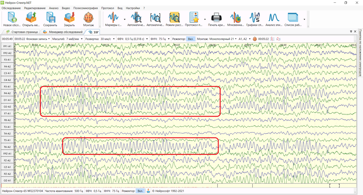 Альфа-ритм здорового человека во время расслабленного бодрствования