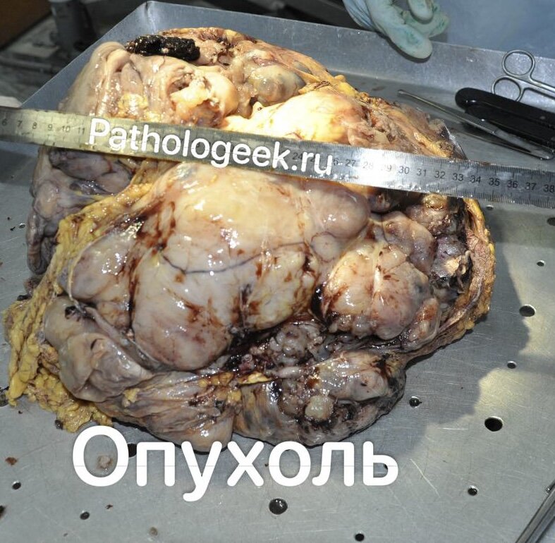 Опухоль