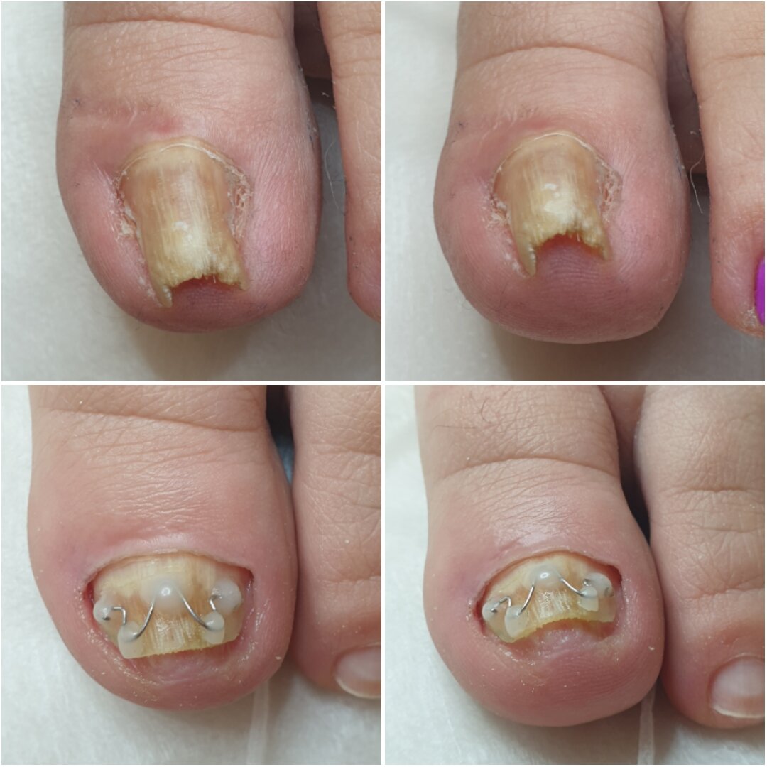 Грибковая инфекция провоцирует деформацию и врастание ногтей.