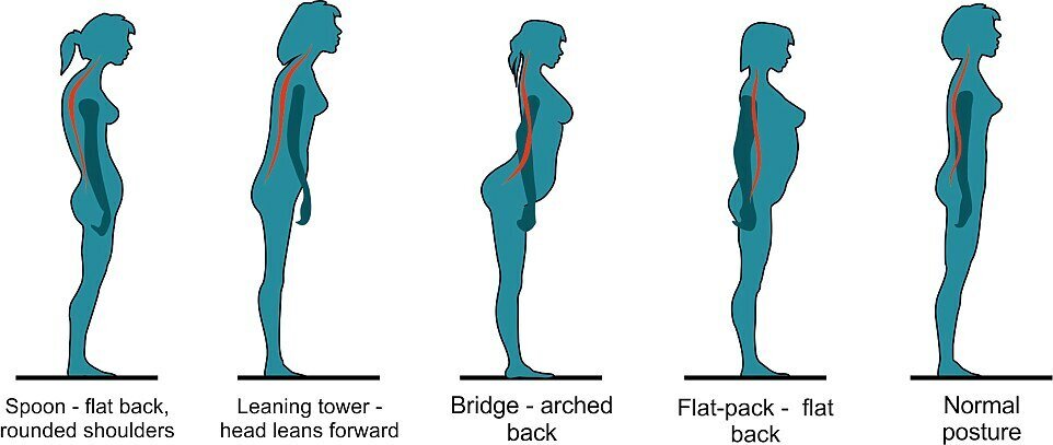 Нарушения осанки