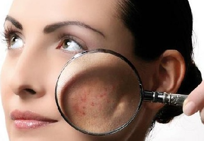 Пример себорейного дерматита.