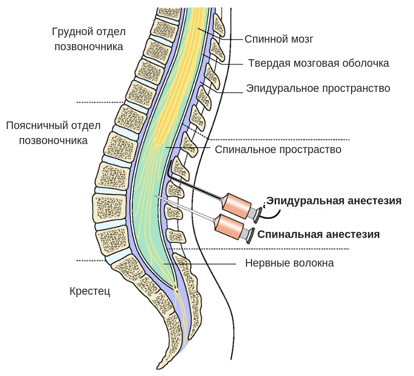 Почему после спинальной. Эпидуральная анестезия строение спинного мозга. Люмбальная эпидуральная анестезия. Спинномозговая анестезия и эпидуральная анестезия отличия. Спинальная анестезия и эпидуральная анатомия.