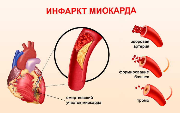 Бессимптомный инфаркт миокарда клиническая картина