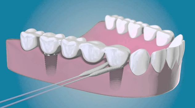 Чистка межзубного пространства с помощью зубной нити и зубной пасты.