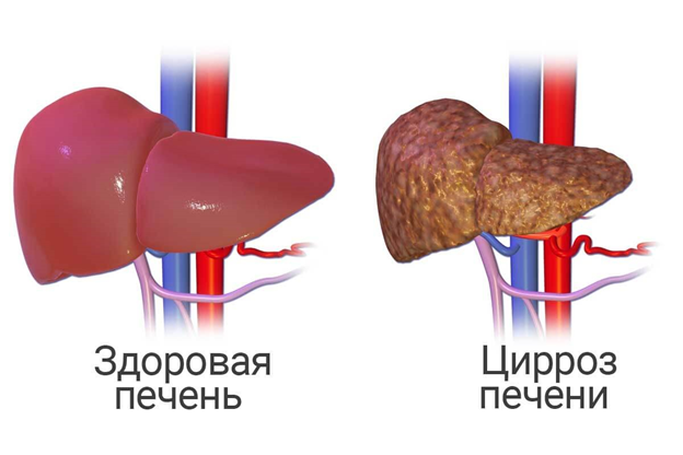 Жировой гепатоз печени — что это, симптомы и лечение