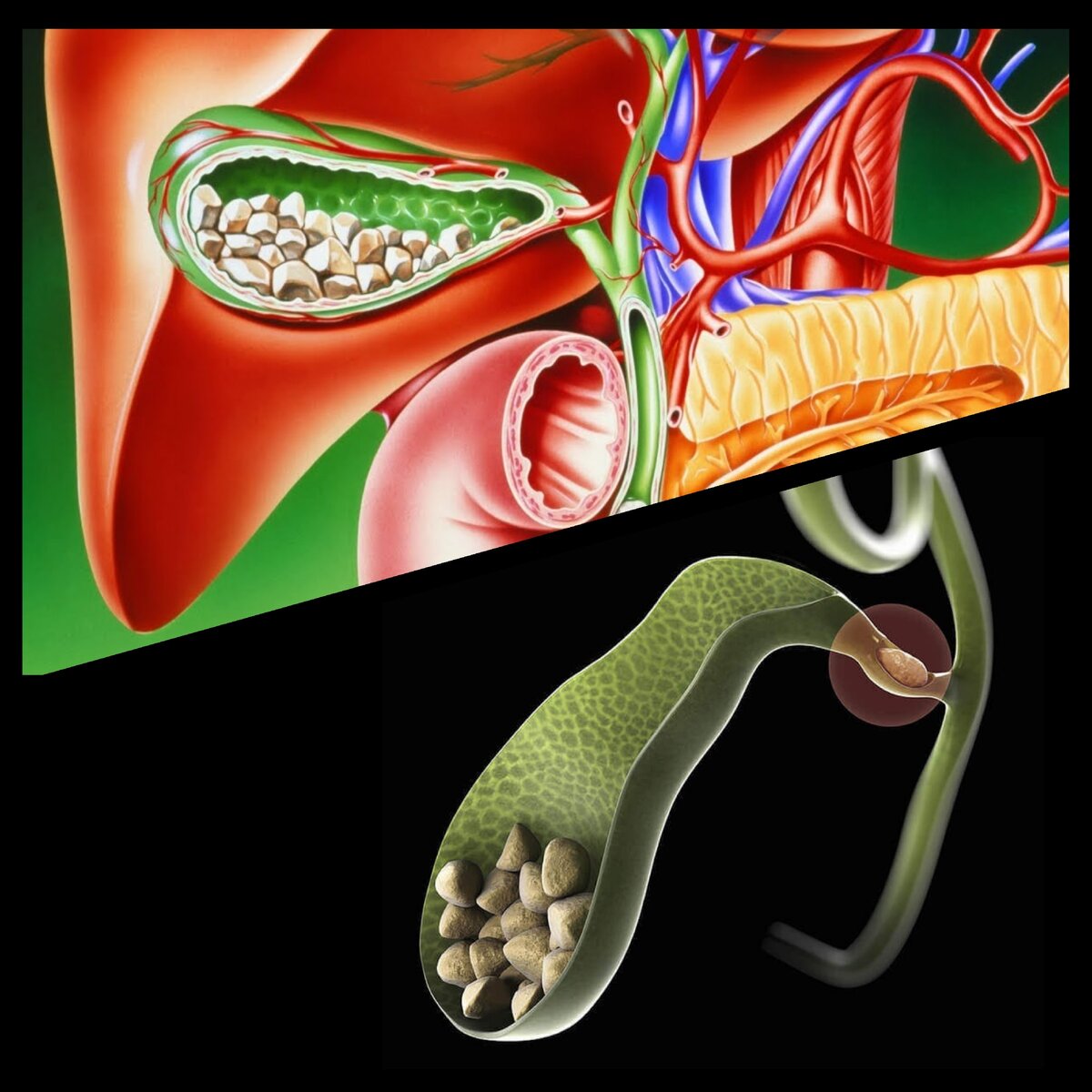 Желчный пузырь камни. Желчекаменная болезнь.