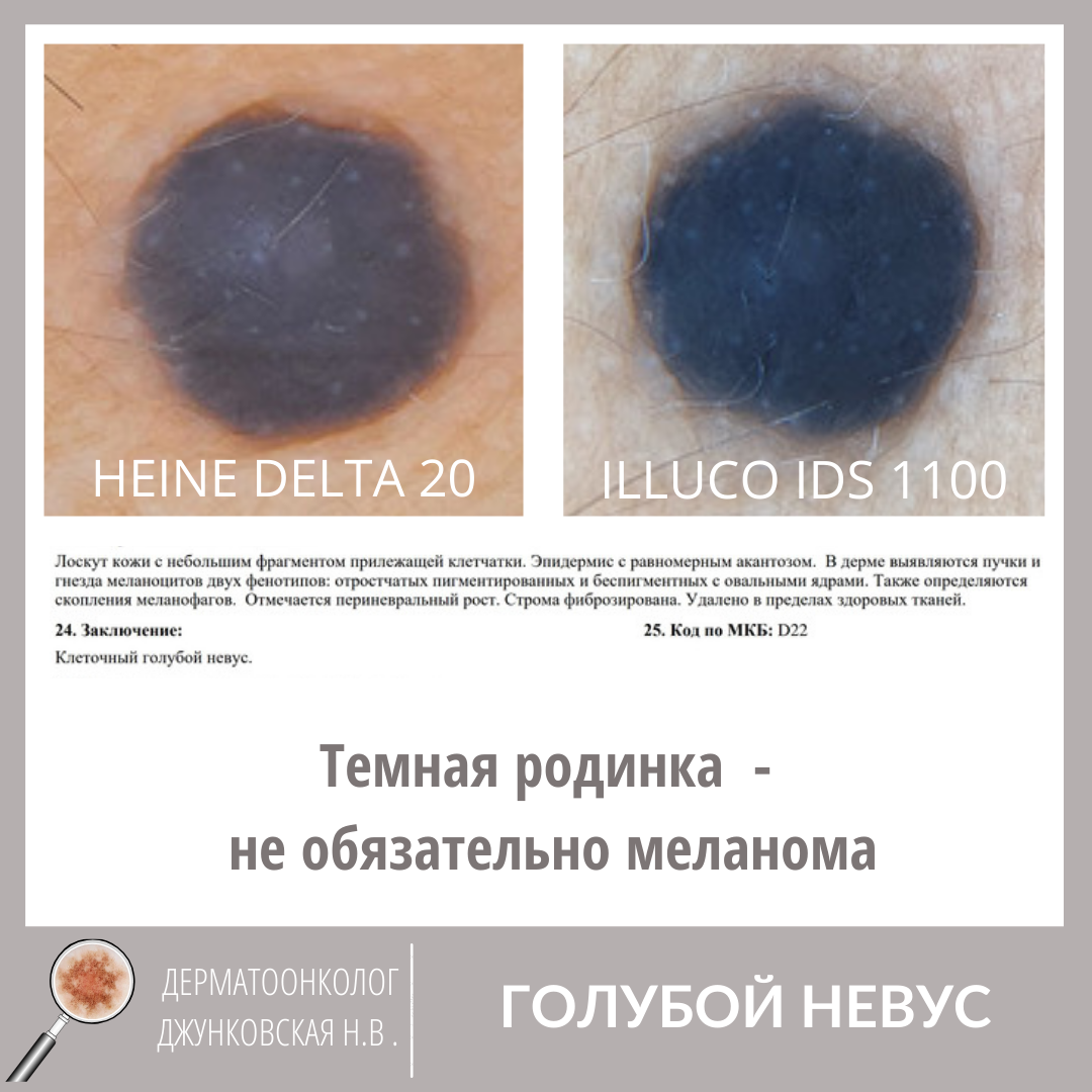 Чешется родинка? Ответ дерматоонколога. | dr.dzhunkovskaya | Дзен