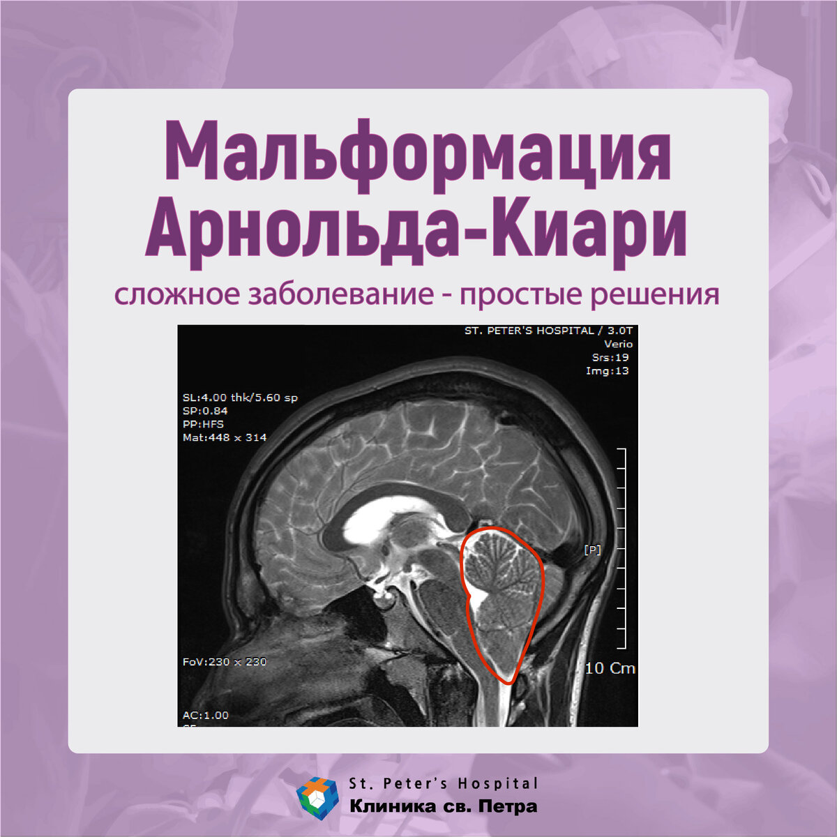 Картина мальформации арнольда киари 1