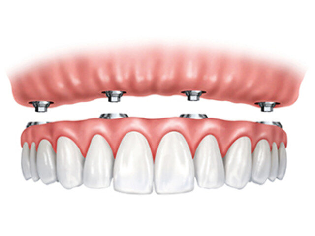 Протокол имплантации All-on-4