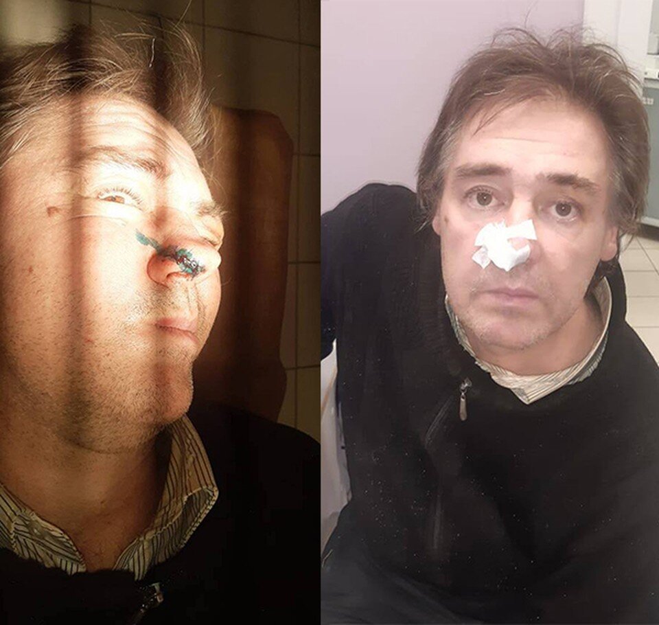     48-летний житель Москвы Михаил Караваев заявил, что сожительница отхватила ему ножом нос.