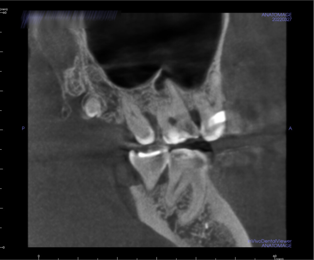 На диагностическом снимке сверхкомплектный 9й зуб