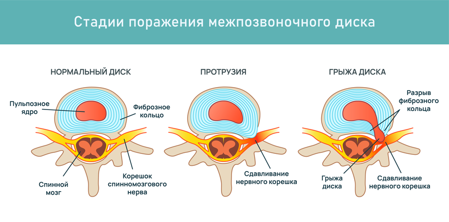 Степени поражения межпозвоночного диска: нормальный диск, протрузия, грыжа диска