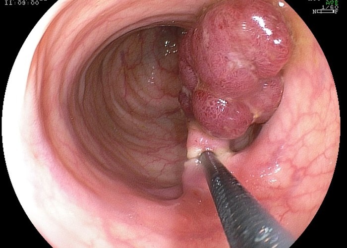 Полип желудка - предраковое заболевание