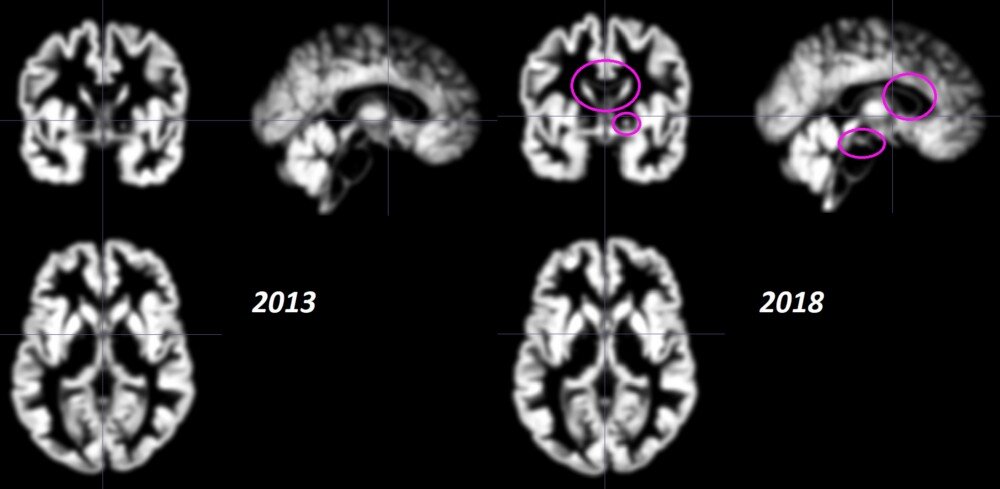 Сканирование серого вещества мозга, сделанное в 2013 и 2018 годах. Несмотря на то, что оно незаметно, на сканировании 2018 года наблюдается большая плотность серого вещества. В отличие от сравнительных сканирований выше, эти сканы были обработаны с использованием специальной техники, которая требуется для анализа.