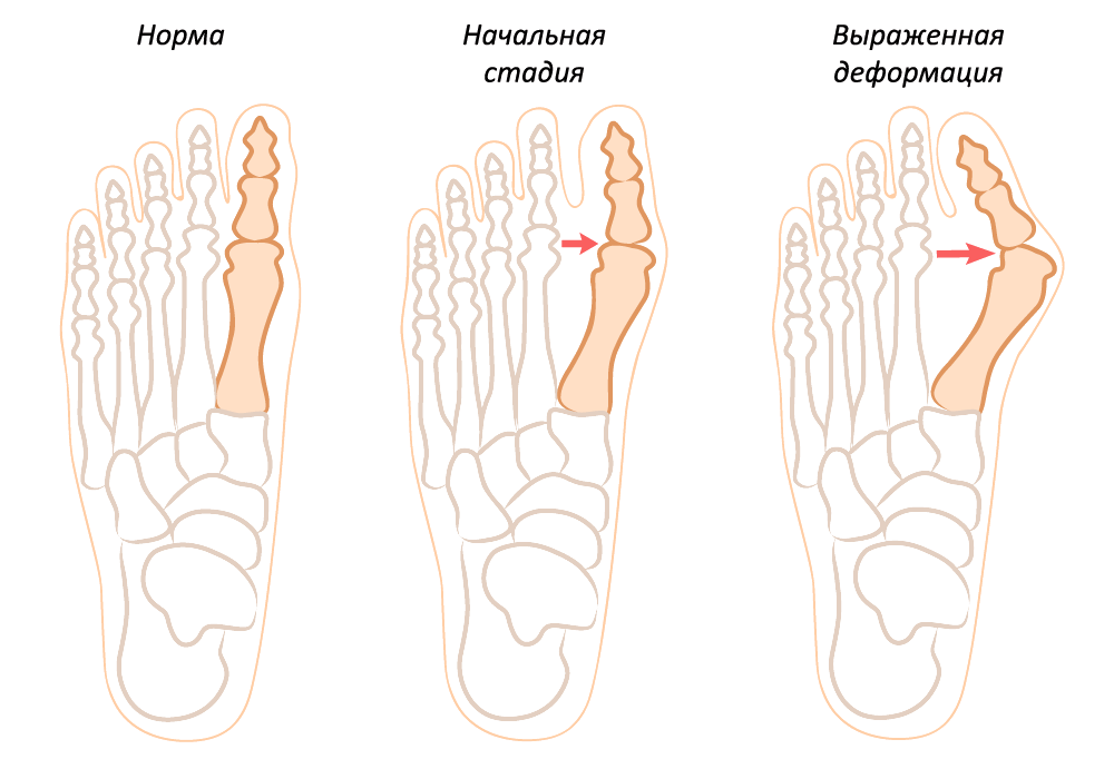 Болит косточка на ноге что делать лечение. Вальгусная деформация 1 пальца. Вальгусная деформация пальца ступни. Степень вальгусной деформации пальца. Вальгусная деформация 1 пальца стопы.