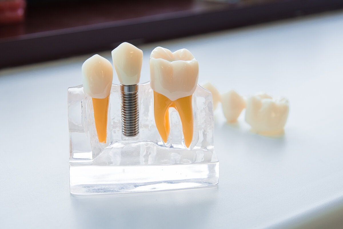 Как понять, когда можно сохранить зуб, а когда нужно удалять?