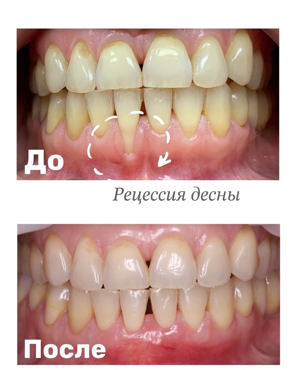 Такая рецессия может быть результатом грубой чистки зубов