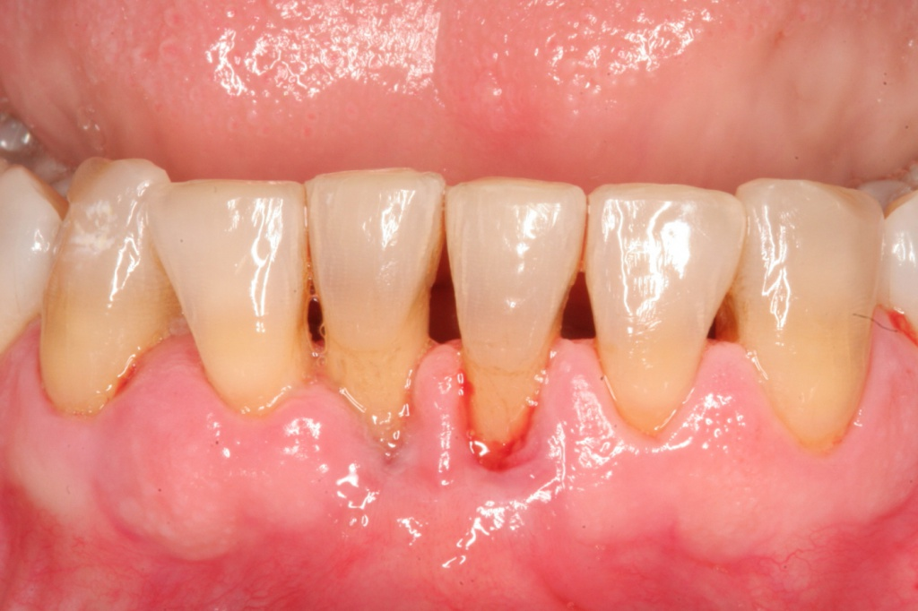 Чем полоскать рот при зубной боли