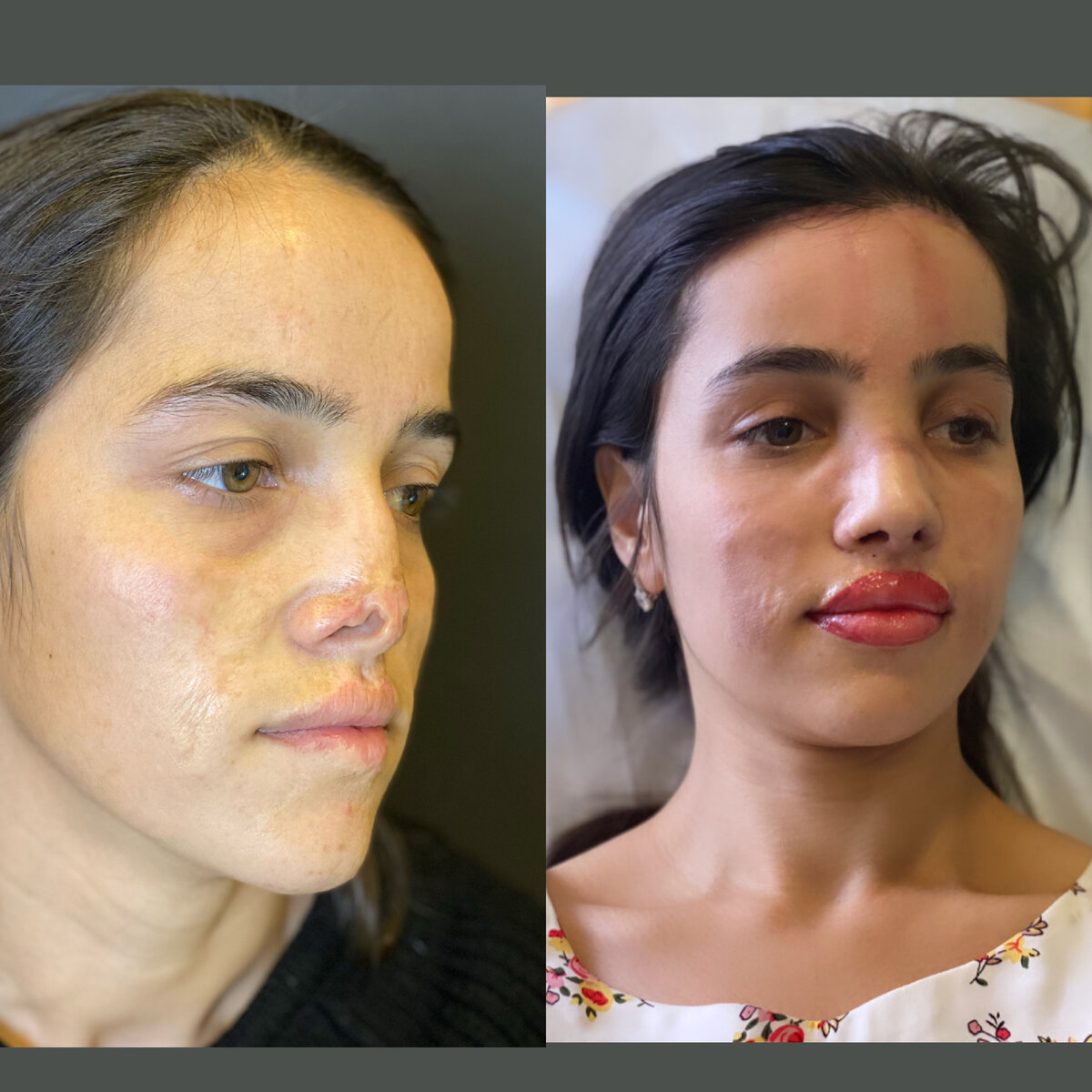 До и после операции "Реконструктивная ринопластика"