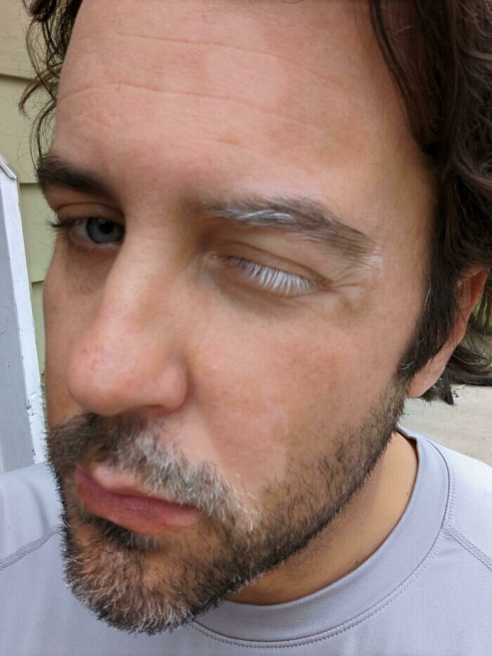 Источник: https://www.reddit.com/r/Vitiligo/comments/tx8uag/wheres_my_white_lash_enjoyersrockers_at_just