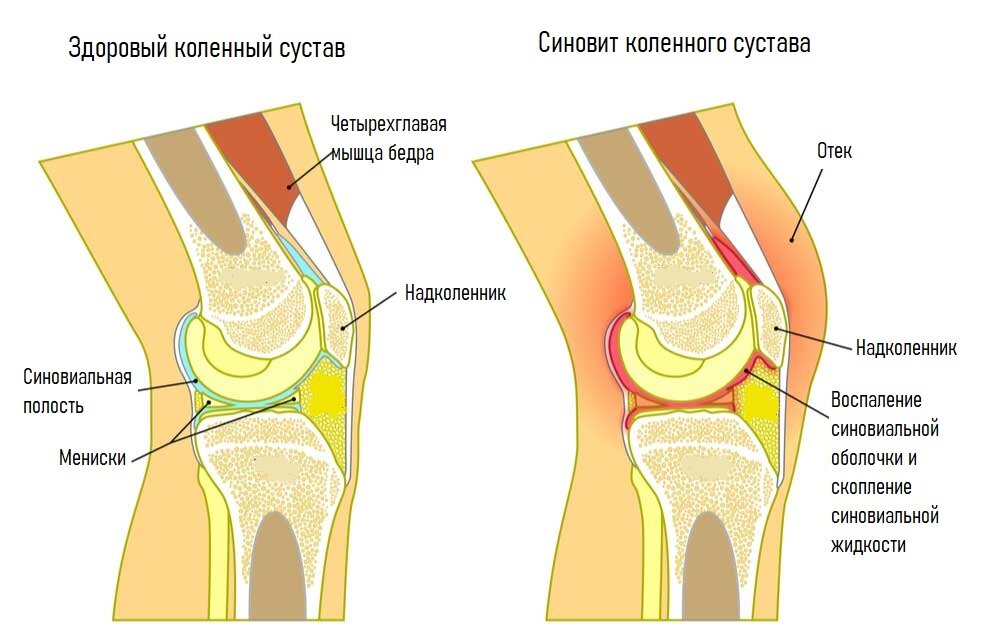 Энтезопатия