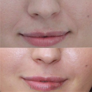 Коррекция носогубной складки, фото с сайта хирурга Д.Р,Гришкяна, имеются противопоказания, требуется консультация специалиста. 