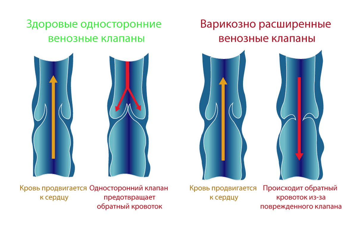 Варикозного расширения вен нижних конечностей у женщин. Стадии варикозного расширения вен нижних. Стадии клинического течения варикозного расширения вен. Варикозное расширение вен нижних конечностей 1 стадия. Варикозная болезнь вен этиология.