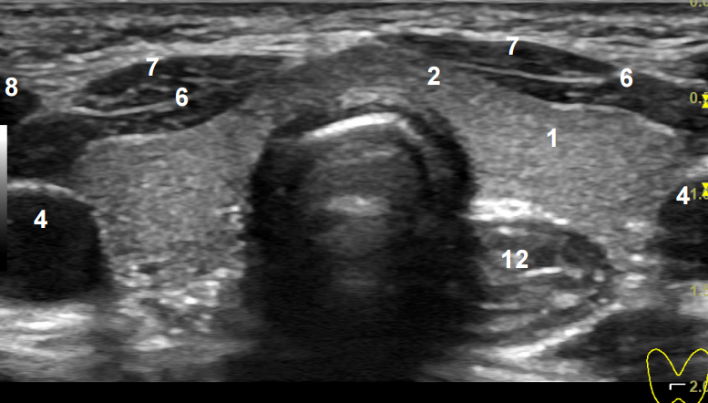 Аплазия щитовидной железы. Ультразвуковая анатомия щитовидной железы. Коллоидная гиперплазия щитовидной железы УЗИ. Лимфатический узел щитовидной железы УЗИ.