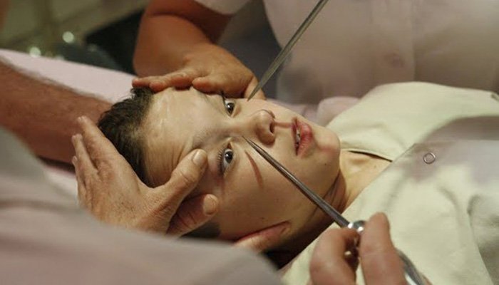 История лоботомии: самая постыдная Нобелевская премия