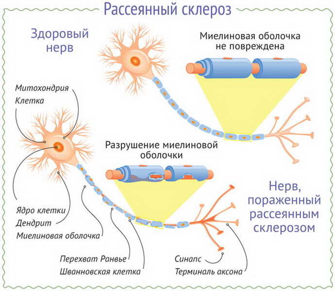 Рассеянный склероз патогенез схема