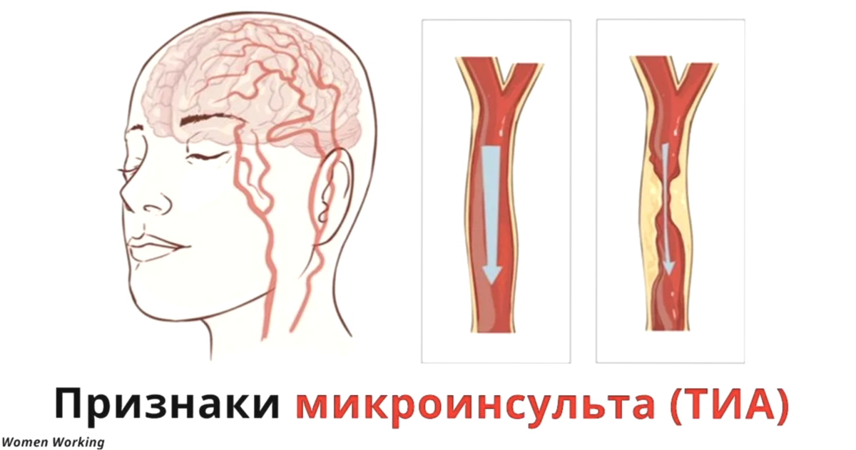 Признаки микроинсульта у женщины перенесенного. Симптоматика микроинсульта. Микроинсульт у женщин. Микроинсайт. Критерии микроинсульта.