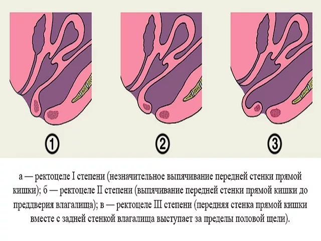 Сухость влагалища