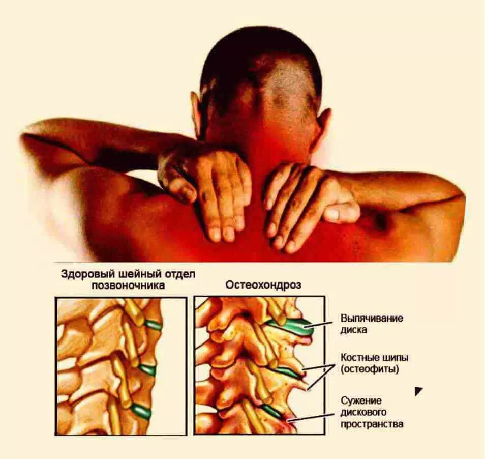 Какие при обострении шейного остеохондроза. Профилактика остеохондроза. Профилактика шейного остеохондроза. Памятка шейный остеохондроз. Профилактика остеохондроза шейного отдела позвоночника.