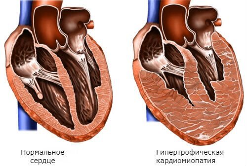 Сердечная недостаточность: симптомы, причины, лечение