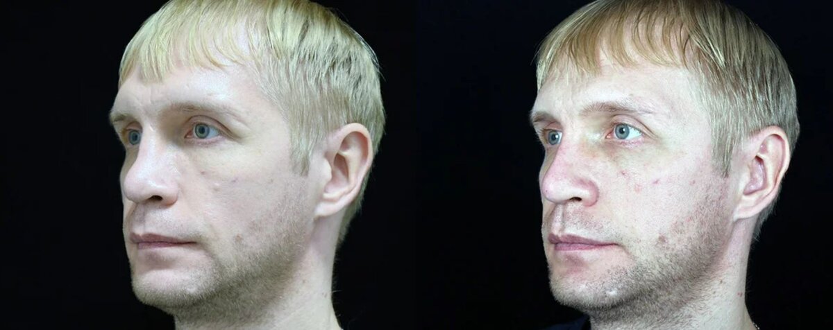 Коррекция носа филлером фото до и после. Фото с сайта Д.Р. Гришкяна. Имеются противопоказания, требуется консультация специалистов