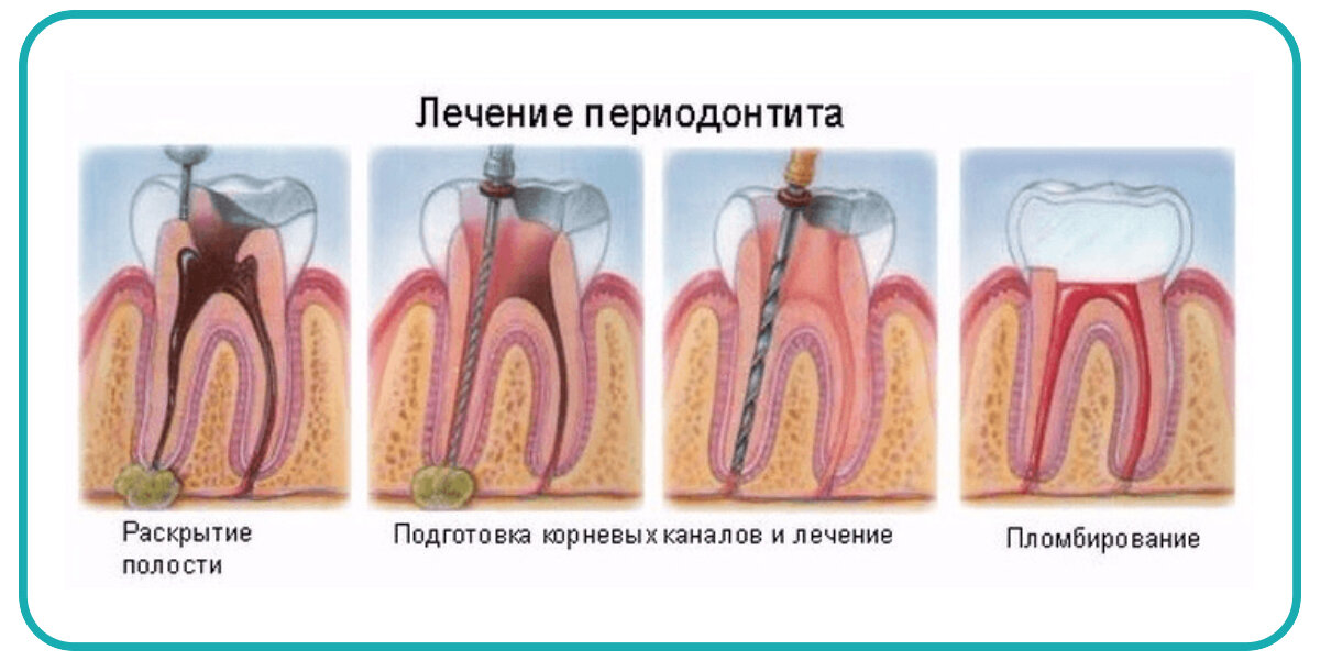 3 корневых каналов. Периодонтит 3-х канальный * — 7500 р.. Хронический периодонтит зуба. Хронический апикальный периодонтит.