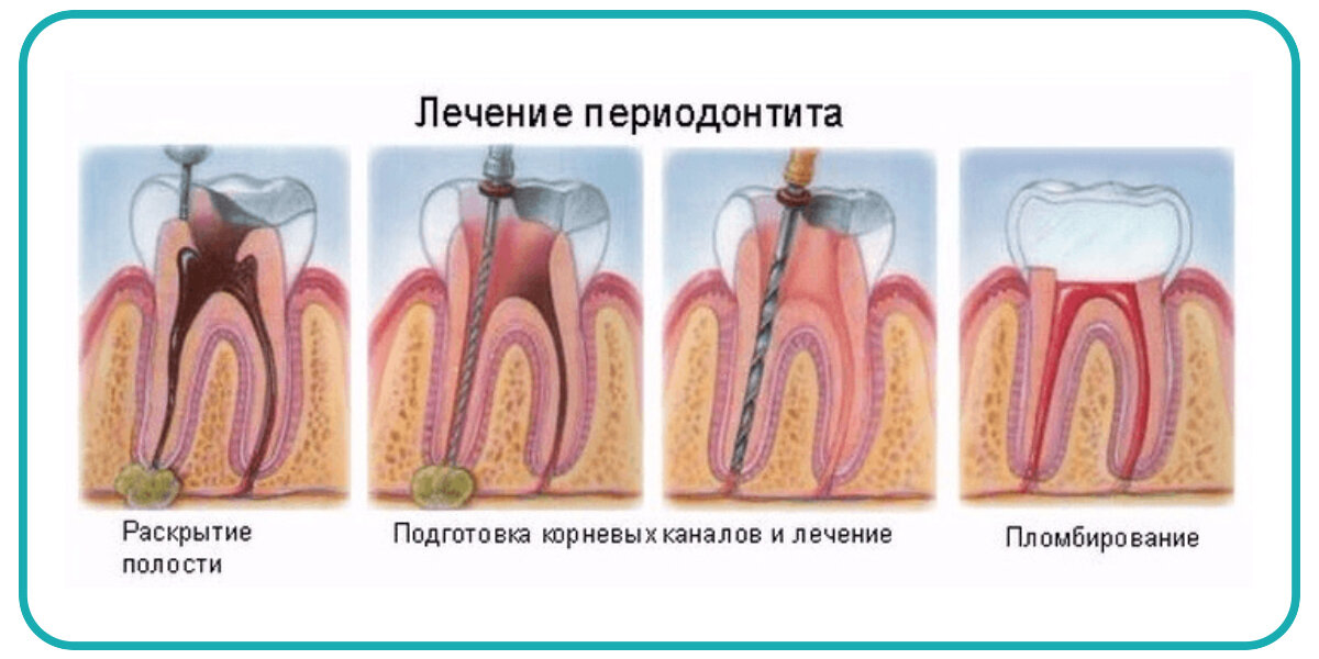 Канал воспаление. Периодонтит 3-х канальный * — 7500 р.. Хронический апикальный периодонтит. Маргинальный периодонтит. Периодонтит стоматология.