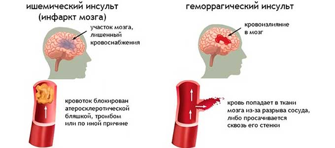 Ишемический инсульт и геморрагический инсульт картинки