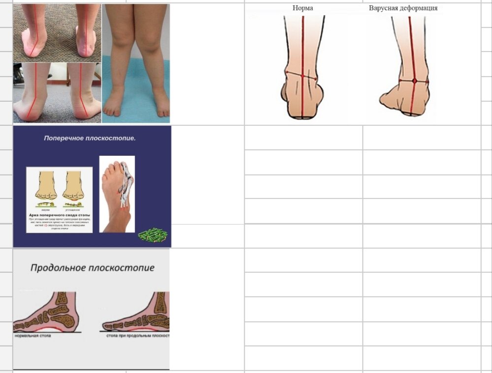 Виды деформации стопы