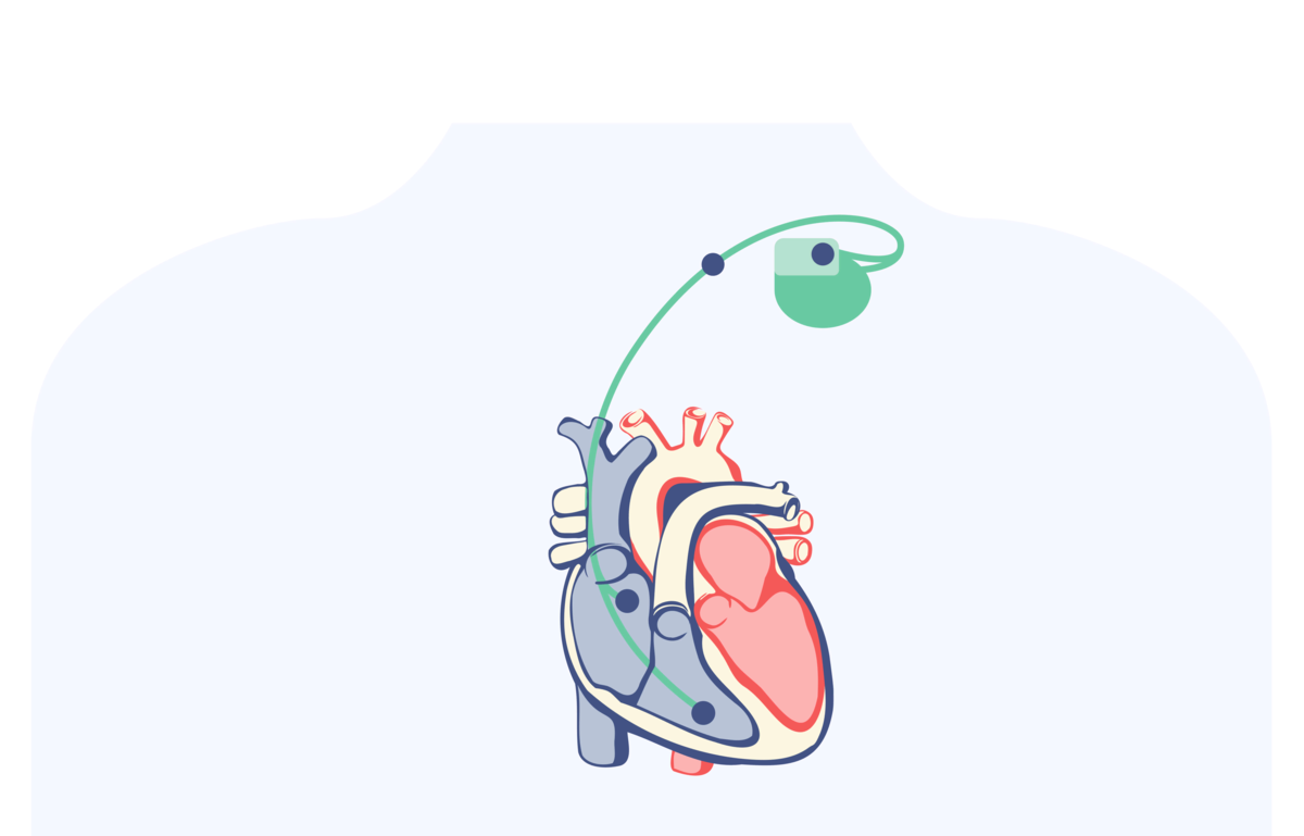 Кардиостимулятор обычно ставят под левой или правой ключицей. Электроды от него через вену проводят к камерам сердца и закрепляют в области водителей ритма. 