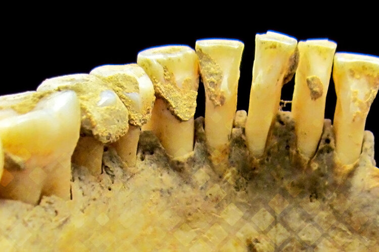 Обильный налет и зубной камень, просевшие десны, боль, кровоточивость, расшатывание и выпадение зубов – это лишь немногие последствия пародонтита. На поздних стадиях зубы выглядят удручающе. Фото: Яндекс.Картинки.