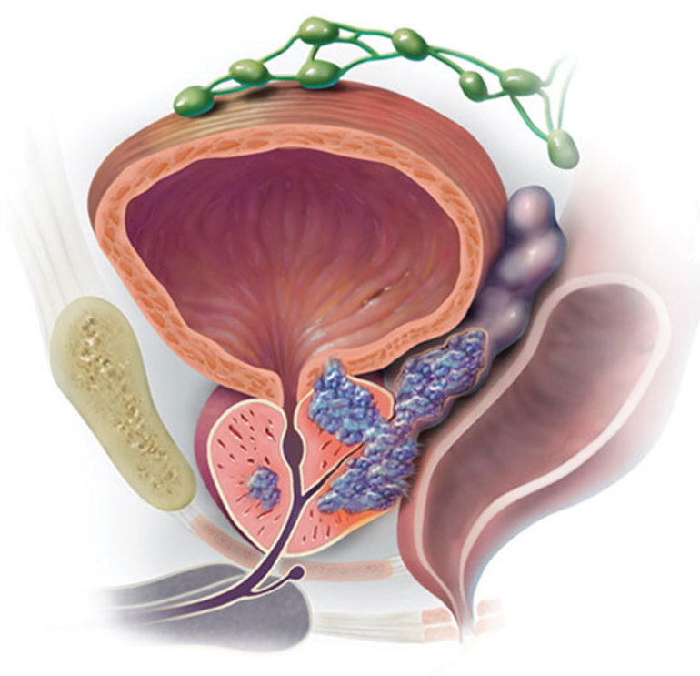 Что такое аденома. Предстательная железа, Prostata. Аденома предстательной железы. Карцинома предстательной железы. Злокачественное новообразование предстательной железы.
