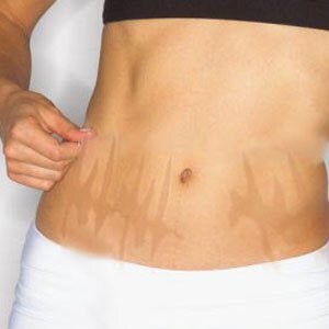 Суть методики состоит в том, что лазер создает тысячи микроканалов, которые стимулируют восстановление кожного покрова за счет собственных ресурсов организма. Специальная насадка делает из одного крупного луча множество микролучей, и тогда повреждения кожи проходят не по всей ее поверхности, а лишь частично, словно через сито.