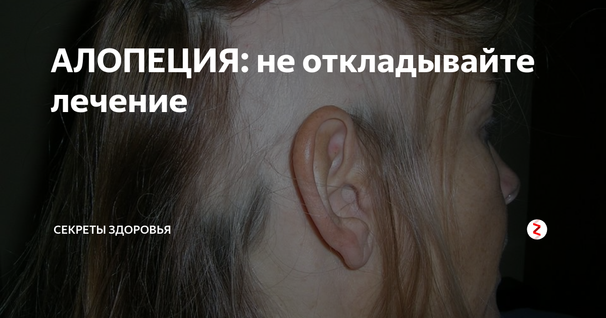 АЛОПЕЦИЯ: не откладывайте лечение | СЕКРЕТЫ ЗДОРОВЬЯ | Дзен