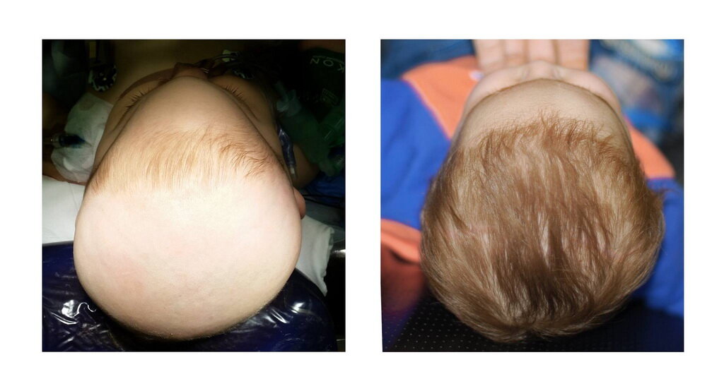 Краниосиностоз (краниостеноз, от греч. cranio — череп и synostosis — сращение костей) — раннее закрытие черепных швов, что способствует ограниченному объему черепа, его деформации и внутричерепной гипертензии. Источник: Википедия