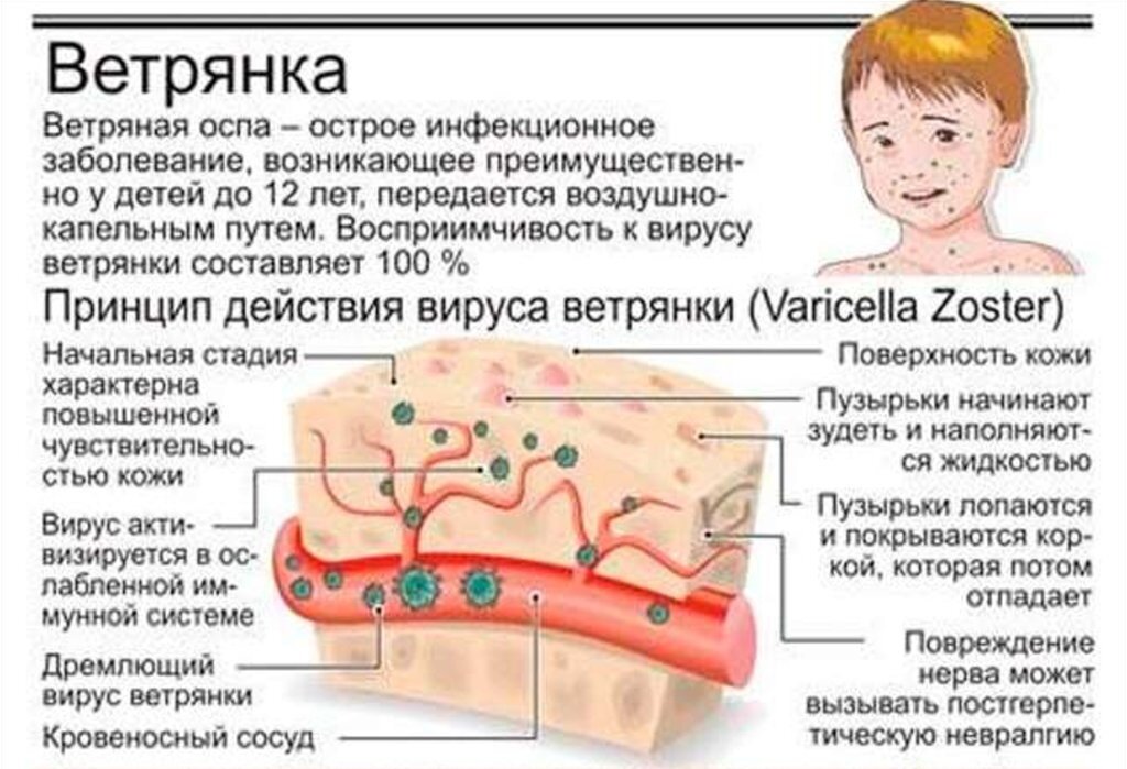 Ветрянка (ветряная оспа), причины, симптомы, лечение